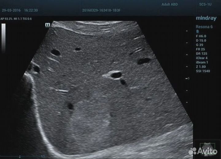 Узи аппарат Mindray Resona 6