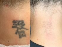 Удаление татуажа : брови,веки, губы, тату