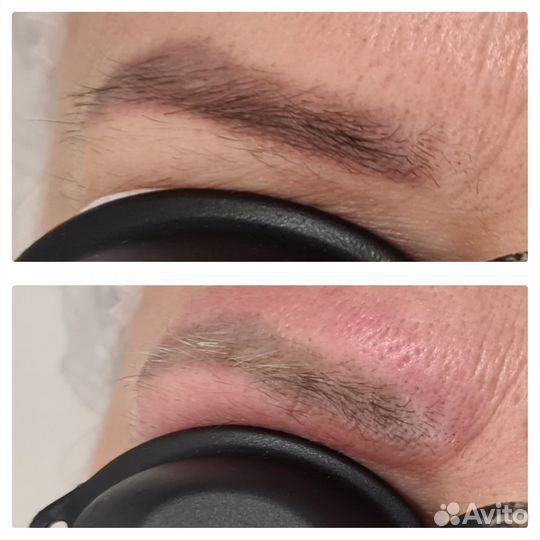 Удаление татуажа. Удаляем стрелки