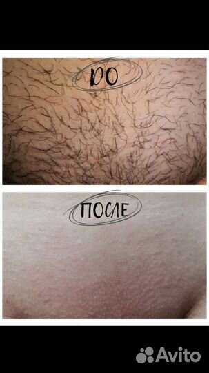 Шугаринг: живот