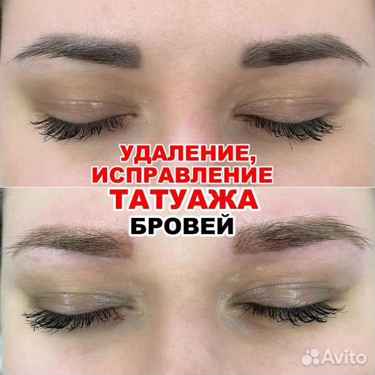 Удаление и исправление татуажа бровей