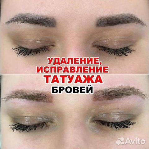 Удаление и исправление татуажа бровей