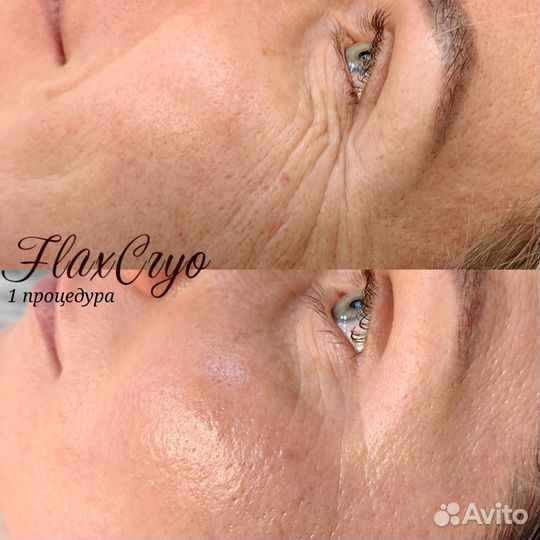 Красота и молодость без уколов и боли