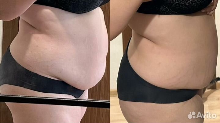 Аппаратная коррекция фигуры