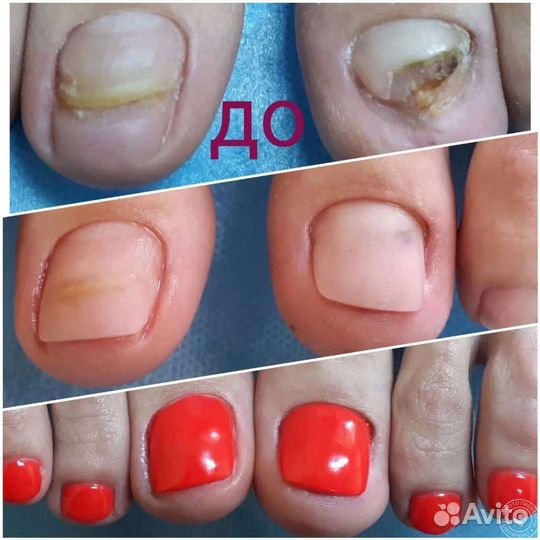 Педикюр с грибком ногтей. Выезд на дом
