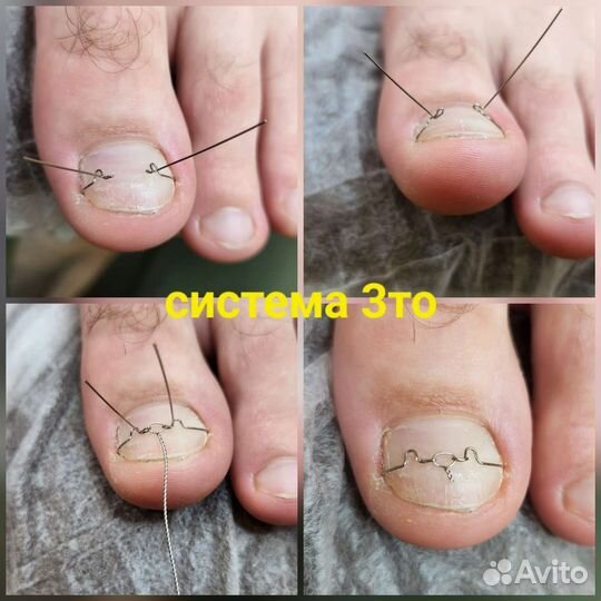 Лечебный педикюр подолог