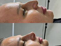 Коррекция носа филлером