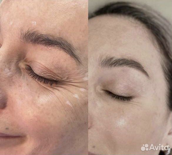 Ботокс лица