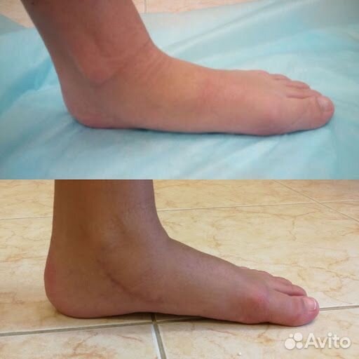 Плоскостопие коррекция