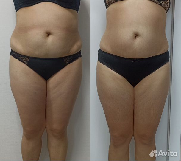 Аппаратная коррекция фигуры