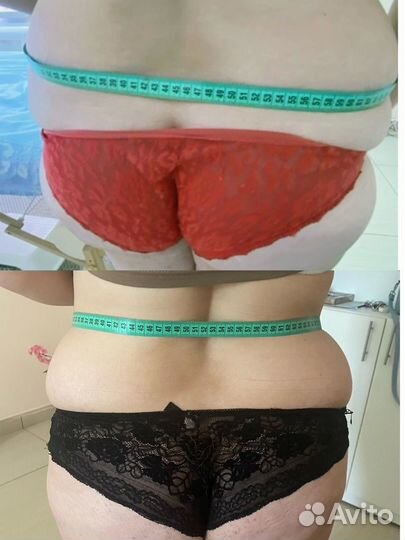 Ультразвуковая кавитация,аппаратный RF массаж