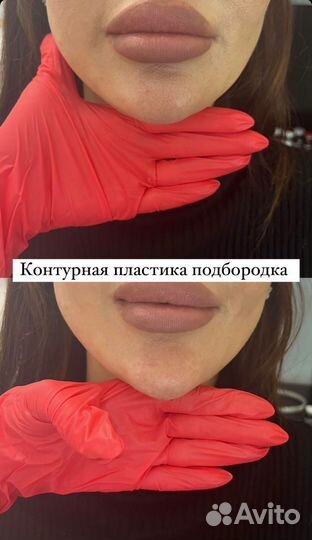 Увеличение губ, ботокс, мезотерапия