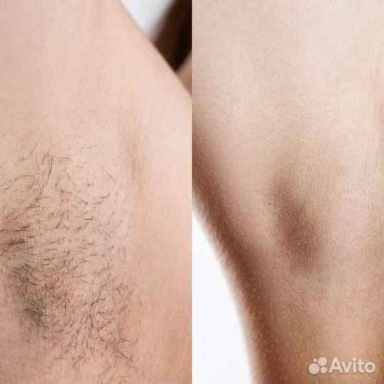 Эпиляция шугаринг