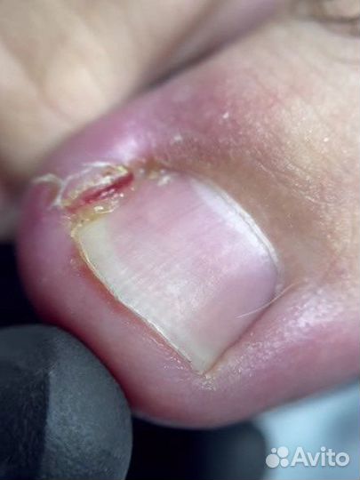 Педикюр медицинский подолог