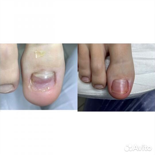 Аппаратный педикюр