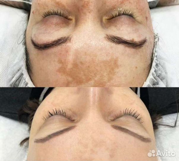 Удаление татуировок, татуажа