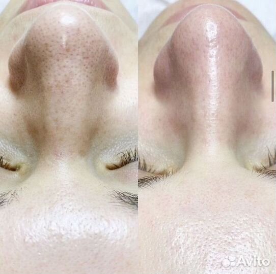 Комбинированная чистка