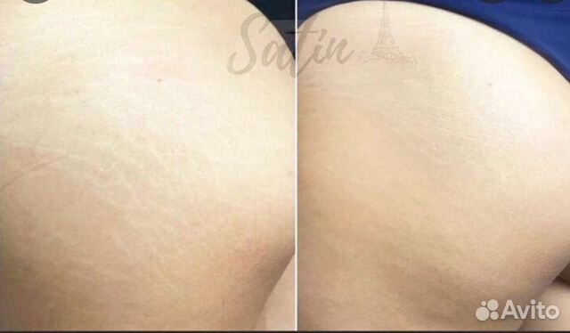 Камуфляж шрамов,растяжек