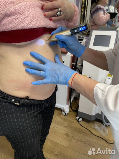 Электрокаогуляция новообразований на лице и теле