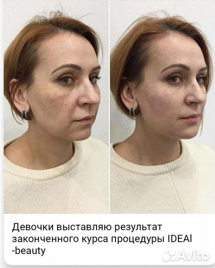 Аппаратное Омоложение лица
