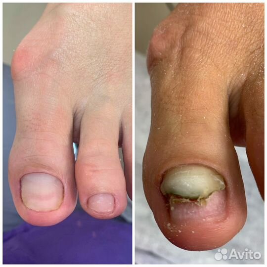 Медицинский педикюр. Подолог