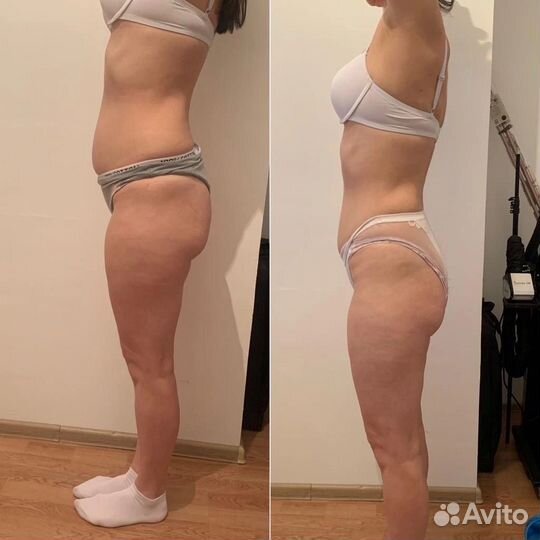 LPG, Эндосфера Кавитация депиляция массаж лица