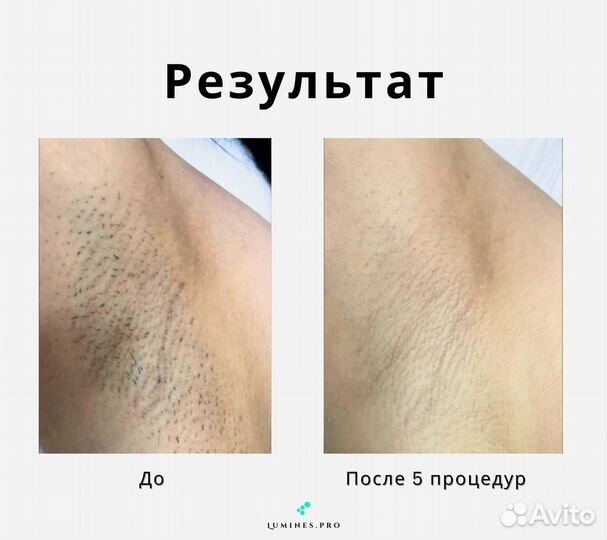 Диодный лазер Лю-Минес Макс-Ван 1200