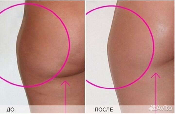 Массаж аппаратный