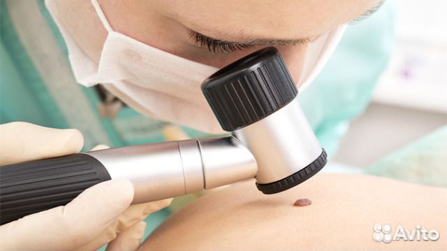 Лазерное удаление новообразований на коже