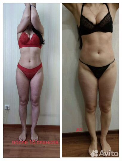 LPG массаж, прессотерапия, миостимуляция