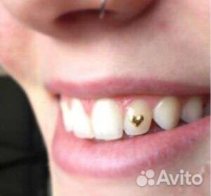 Установка скайсов на зубы