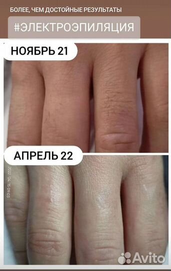 Электроэпиляция