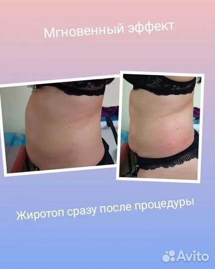 Липолитики мезотерапия