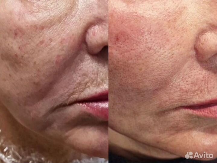 Микроигольчатый RF лифтинг косметолог омоложение