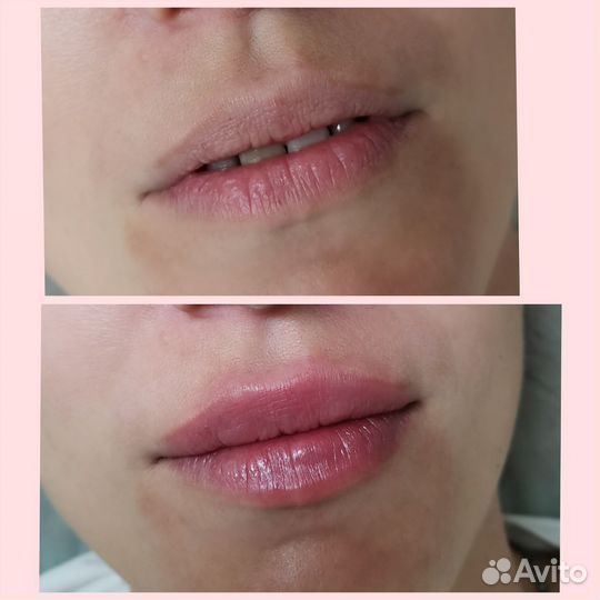 Контурная пластика губ