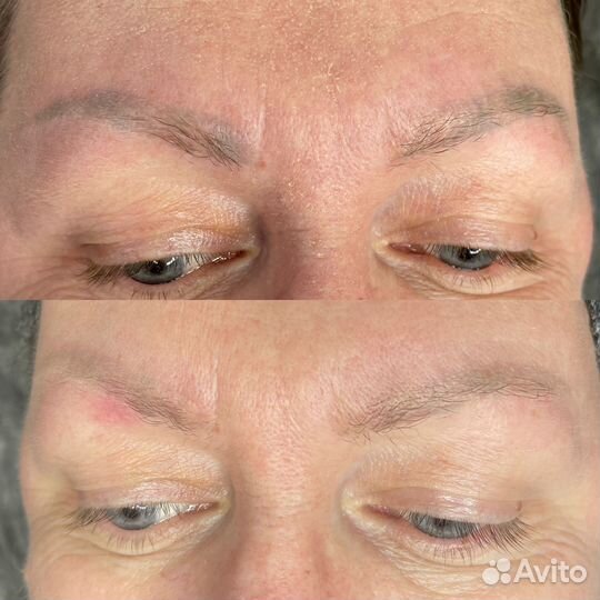 Удаление татуажа перманентного макияжа бровей губ