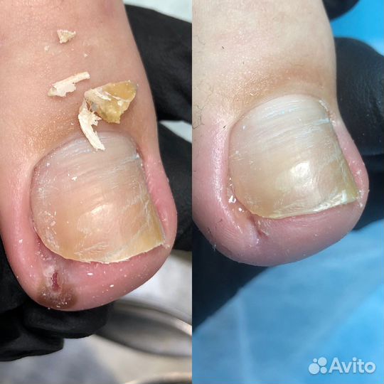 Педикюр Подолог Вросший ноготь Ростов