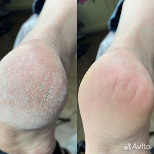 Подолог. Вросшие ногти, трещины, мозоли