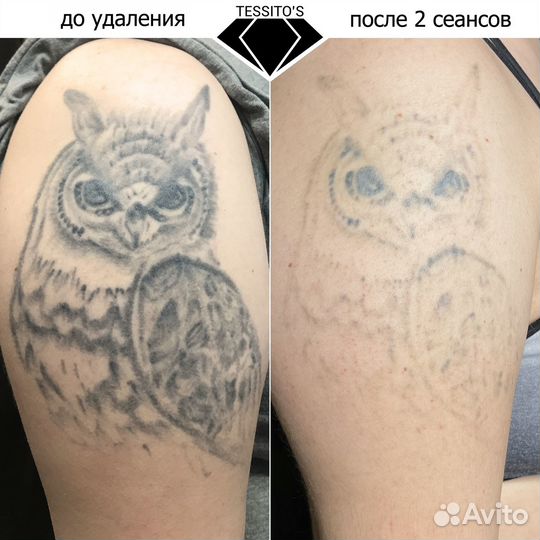 Удаление тату