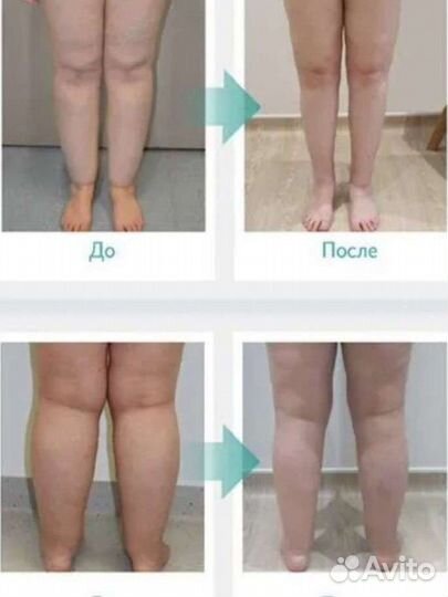 Прессотерапия