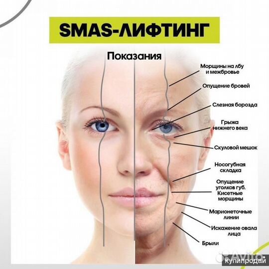 СМАС лифтинг