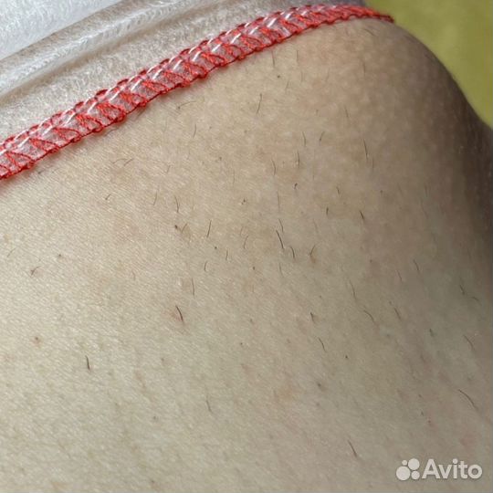 Электроэпиляция