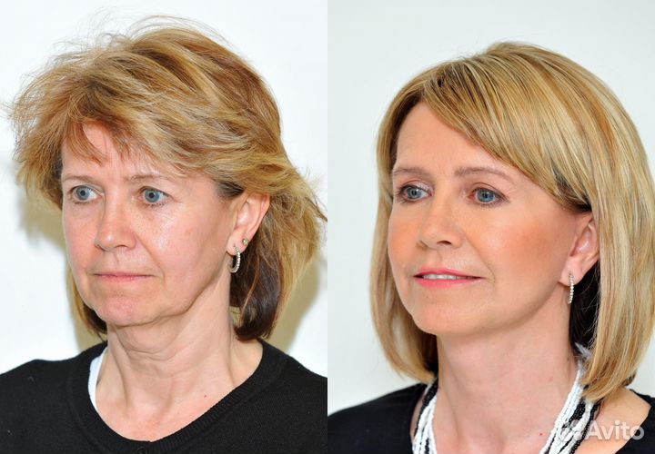 Модели на Смас лифтинг лица без оплаты