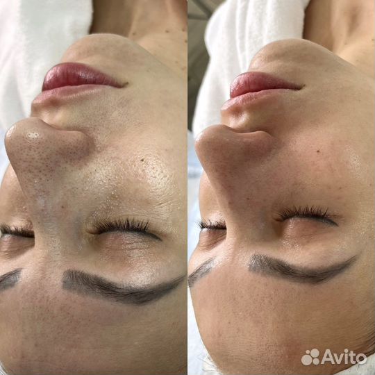 Плазмолифтинг