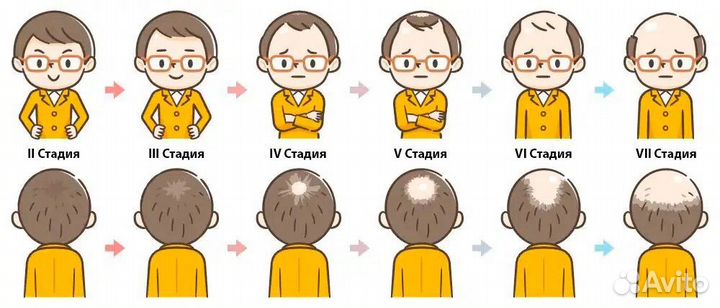 Пересадка волос по современной методике