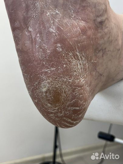 Лечебный педикюр выезд на дом подолог