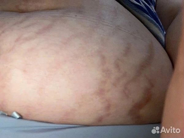 Сыворотка от растяжек