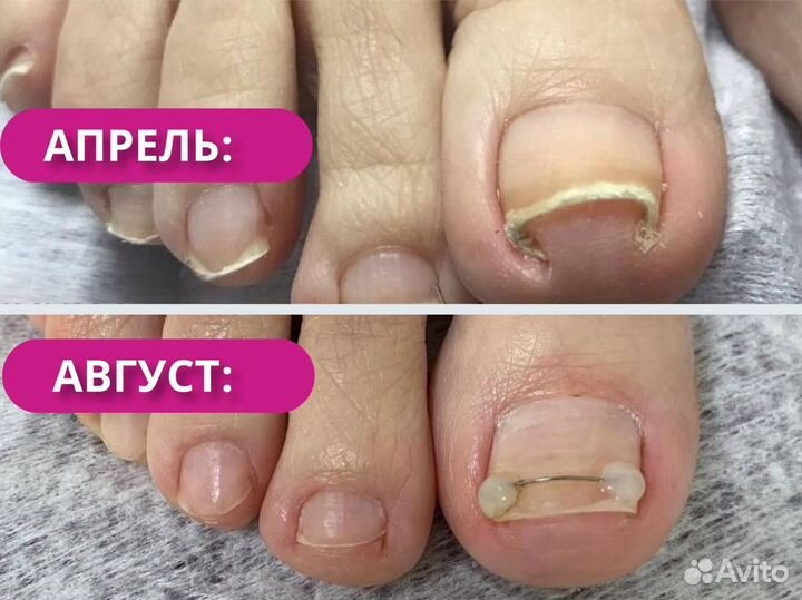 Лечение вросшего ногтя. Здоровый ноготок за 4 сеан