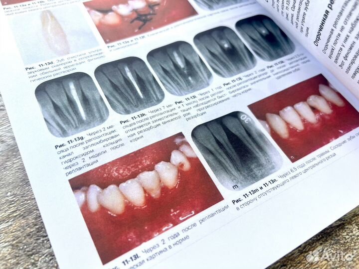 Травма зубов