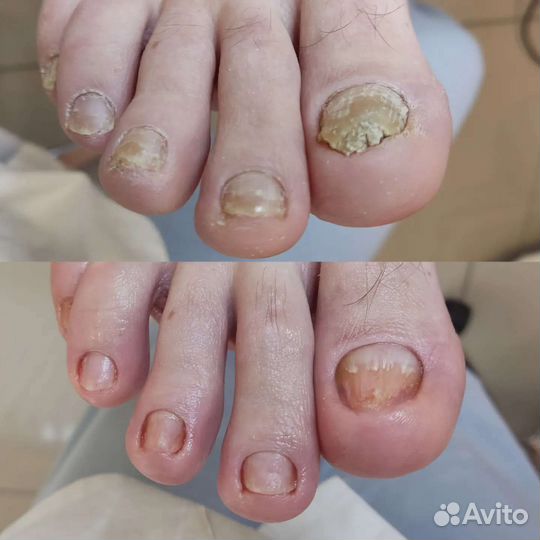 Педикюр, подолог